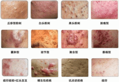 重庆渝中区第三人民医院解析青春痘症状