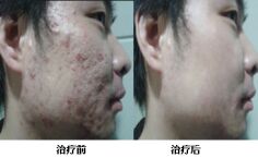 重庆渝中区第三人民医院治疗青春痘案例
